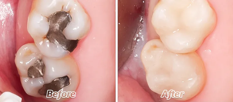 Remocion de empastes de amalgama antes y despues
