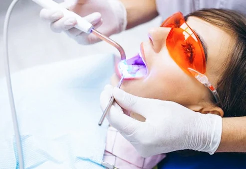 Blanqueamiento dental con láser en San Diego