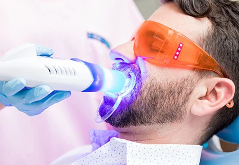Blanqueamiento dental con Zoom en San Diego
