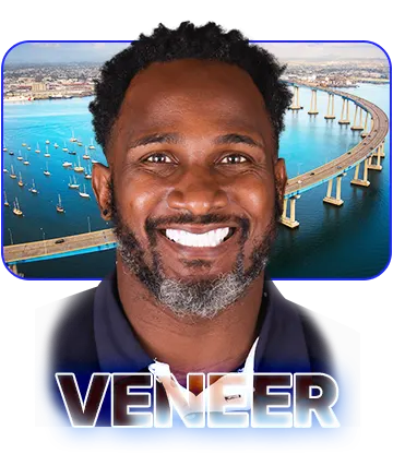 Resultado de Carillas de Resina