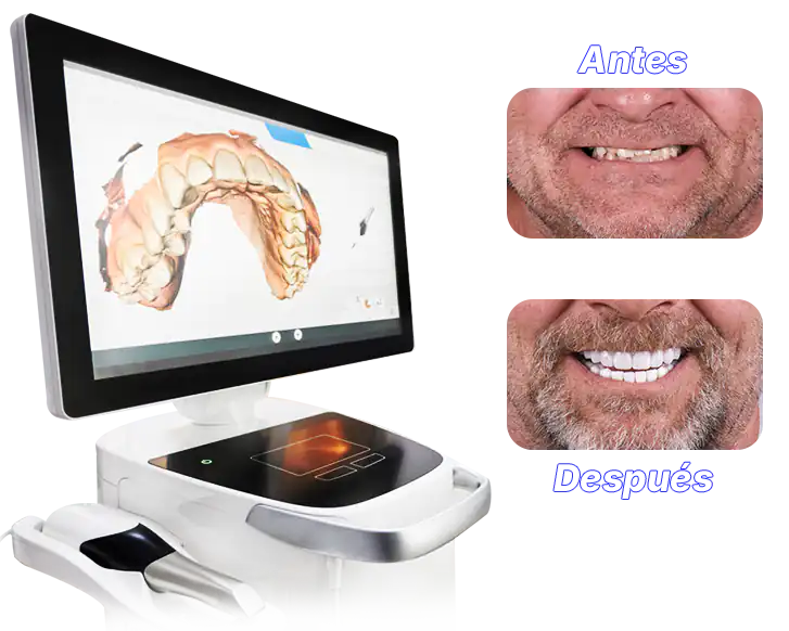 Resultados de uso de carillas con CEREC