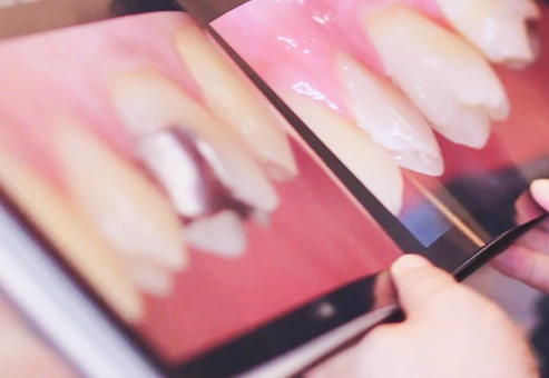 Tratamiento intraoral en endodoncia infectada