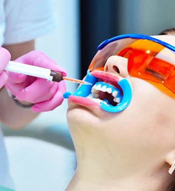 Paso 3: Aplicación del blanqueamiento