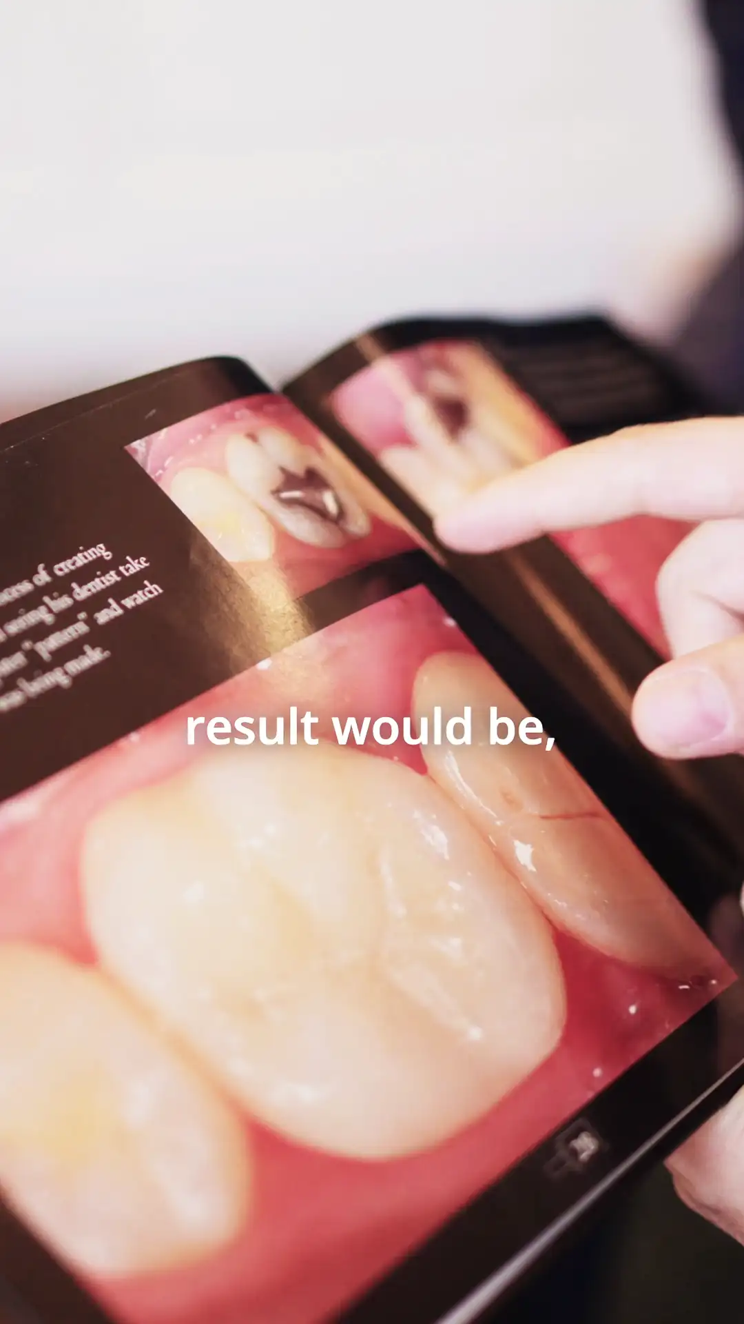 Extraccion de amalgamas dentales en un día en Navajo, experiencia de paciente