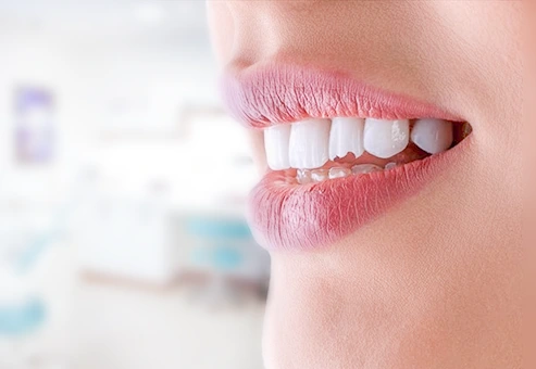 Ruptura o astillado de diente en paciente de dental expression