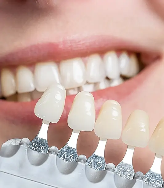 Carillas de porcelana de primera calidad en San Diego