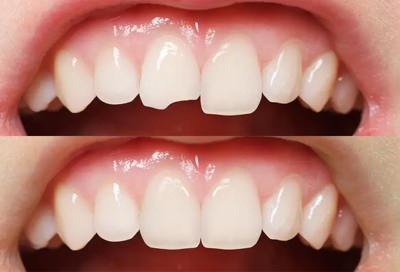 Adhesión dental antes y después