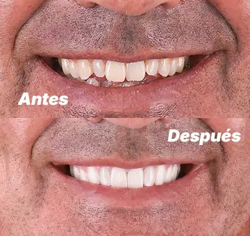 Carillas dentales antes y después