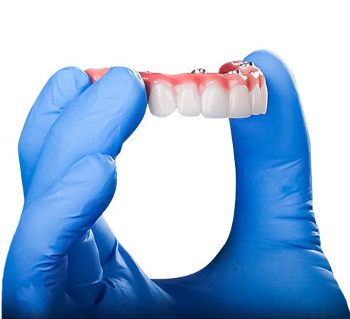 Mano sosteniendo una prótesis fija soportada por implantes