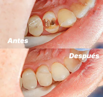 Endodoncia profesional en San Diego antes y después