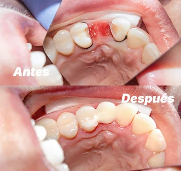 Extraccion dental en San Diego antes y después