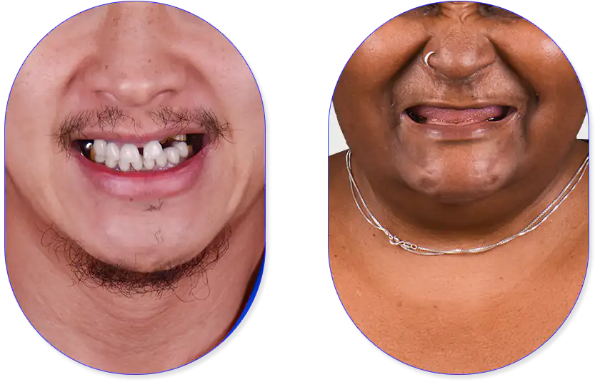 Pacientes masculino y femenino antes de realizarce su tratamiento de implantes dentales