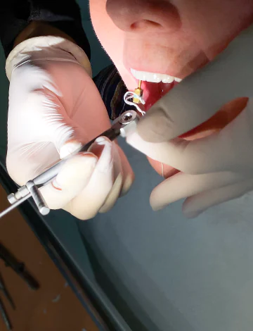 Colocación de implantes en la mandíbula inferior