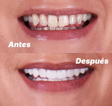 Resina dental estética en San Diego antes y después