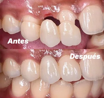 Puente dental de 3 unidades antes y después