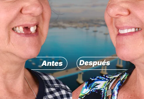 Fabricación de soluciones dentalespersonalizadas, proceso de personalizacion dental
