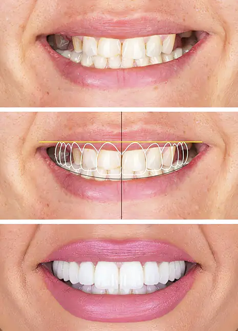Diseño de Sonrrisas a la medida, Dental Expression